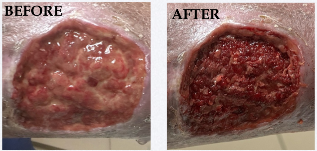 XSONX Wound Care Before and After Pic 1. Haus of Life and Co